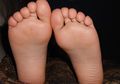 Mata Ikan di Kaki Bisa Menular Tidak, ya? Cari Tahu Penyebabnya, yuk!