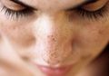 Inilah Perbedaan Dark Spot dan Sun Spot Serta Cara Mengatasinya!