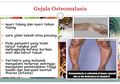 Jarang yang Tahu, Padahal Osteomalasia Sebabkan Gagal Tumbuh Pada Anak