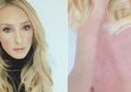 Perempuan Ini 'Menyatu' dengan Saudara Kembar saat dalam Rahim, Kondisi Langka!