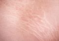 Tanpa Bahan Kimia, 4 Bahan Alami Ini Mampu Hilangkan Stretch Mark Lo!