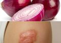 Tempelkan Bawang Merah Pada Keloid Secara Rutin, Ini yang Akan Terjadi