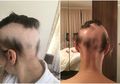 Stres Siapkan Pernikahan, Rambut Wanita Ini Rontok Jelang Hari-H