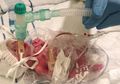 Selamat dari Maut, Bayi Berbobot 500 Gram Ini Buktikan Keajaiban Itu Ada, Lihat Kondisinya Setelah 2 Tahun