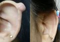 Awas! Tutorial DIY di YouTube untuk Hilangkan Keloid Ini Justru Bisa Akibatkan Kematian