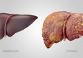 Inilah Hal-hal yang Membahayakan Liver atau Hati, Catat! Nomor 4 Tak Disangka