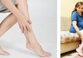 Tak Harus ke Dokter! Inilah Cara Mengobati Varises Bagi Perempuan