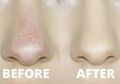 Kulit Di Sekitar Hidung Kering dan Mengelupas, Ini Cara Mengatasinya