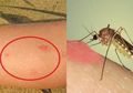 Menghilangkan Gatal Akibat Gigitan Nyamuk Cukup Pakai Kulit Buah Ini!