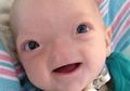 Kisah Bayi Finch, Walau Lahir Tanpa Hidung Tapi Ia Selalu Tersenyum