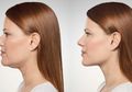 Atasi Double Chin dengan Mangunyah Permen Karet, Memangnya Bisa? Berikut Penjelasannya