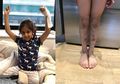 Kaki Penuh Lebam, Disangka Kena Benturan, Ternyata Ia Menderita Penyakit Mematikan..