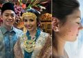 Inilah Ciri-ciri Orang Berisiko Tinggi Kanker Kulit Melanoma Seperti Adara Taista