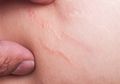 3 Cara Rumahan Ini Bisa Hilangkan Stretchmark di Payudara, Mau Coba?