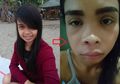 Tak Sengaja Pecahkan Jerawat Kecil di Lubang Hidung, Wanita Ini Alami Nasib Malang