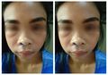 Punya Jerawat di Area Segitiga Maut Wajah, Perempuan Ini Hampir Tewas