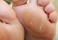 Siapa Sangka Ramuan ini Dapat Menghilangkan Kapalan di Telapak Kaki