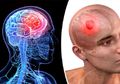 Tidak Ada Bukti Ilmiah yang Membuktikan Gadget Picu Tumor Otak