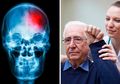Ini 6 Peringatan Stroke akan Menyerang Anda, Jangan Abaikan!