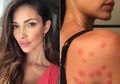 Model Victoria's Secret Ini Gugat Sebuah Hotel karena Alami Luka di Sekujur Tubuh
