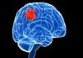 Ini Dia Hal Penting Yang Perlu Kita Tahu Tentang Tumor Otak