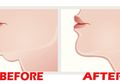 Jangan Galau Lagi! Ada Cara Mudah Hilangkan Double Chin dalam 6 Hari