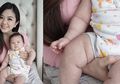 Belajar Dari Pengalaman Franda, Kenali 5 Jenis Penyebab Bintik Merah Di Kulit Anak