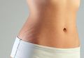Wah, Ternyata 3 Bahan Ini Bisa Hilangkan Stretch Marks di Tubuh