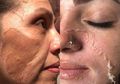 Mengerikan, Jika Dibiarkan Melasma Dapat Merusak Penampilan!