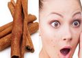 Menakjubkan! Jerawat Minggat Hanya dengan Masker Kayu Manis Buatan Rumah