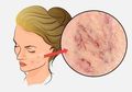 Begini Caranya Menyingkirkan Spider Veins yang Bersarang di Tubuh