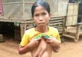 Viral, Seorang Remaja Asal Filipina Miliki Lengan Menempel di Perutnya