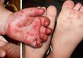 Waspada, Penyakit Flu Singapura yang Mudah Menular dan Rentan Menyerang Anak Merebak di Malaysia