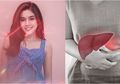 Fay Nabila 'Orang Ketiga' Sakit Liver, Tanda Awalnya Ternyata Sepele!