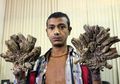 Begini Kabar Terakhir Abul Bajandar Si Manusia Pohon Asal Banglades