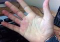 Jangan Lagi Diabaikan! Tangan Kemerahan Bisa Jadi Gejala Penyakit Serius