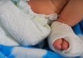 Diduga Lalai, Jari-jari Kaki Kiri Bayi Terpotong Oleh Perawat
