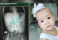 Anak Tidak Rewel Sama Sekali, Ibu Ini Kaget Temukan Anting Di Dalam Tubuhnya
