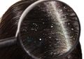 Rambut Masih Berketombe? Coba Buat Resep dari Campuran Jahe Ini