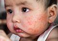 Waspadai Tanda Dermatitis Atopik pada Kulit Bayi yang Berbahaya
