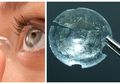 Ngeri, Wanita Ini 'Menyimpan' Contact Lens Di Balik Kelopak Matanya Selama 28 Tahun