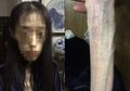 Bermula dari Diet Ketat, Perempuan Ini Malah Merusak Otaknya Hingga Koma 40 Hari!