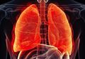 6 Penyebab Kanker Paru-paru yang Tidak Berkaitan Dengan Rokok, Catat!