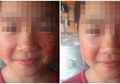 Kondisi Medis Langka Membuat Gadis 11 Tahun Ini Berkeringat Darah