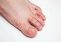 Jika Kaki Terkelupas atau Melepuh, 4 Bahan Rumahan Ini Bisa Mengatasinya dengan Mudah
