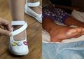 Gadis 4 Tahun Kena Infeksi Mematikan Setelah Coba Sepatu Tanpa Kaus Kaki, Bisakah Hal Itu Terjadi pada Semua Orang?