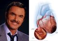 Bintang Hollywood Burt Reynolds Meninggal karena Serangan Jantung: 5 Olahraga Ini Bisa Cegahnya