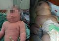 8 Fakta Bayi Bermata Satu di Mandailing Natal, Saat Lahir Tidak Menangis