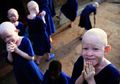 Kehidupan Tragis Orang Albino di Afrika, Jadi Buruan karena Bagian Tubuhnya Dianggap 'Bertuah'