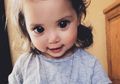 Di Balik Mata Unyu Gadis Cilik Ini, Ternyata Penyebabnya Penyakit Berbahaya!